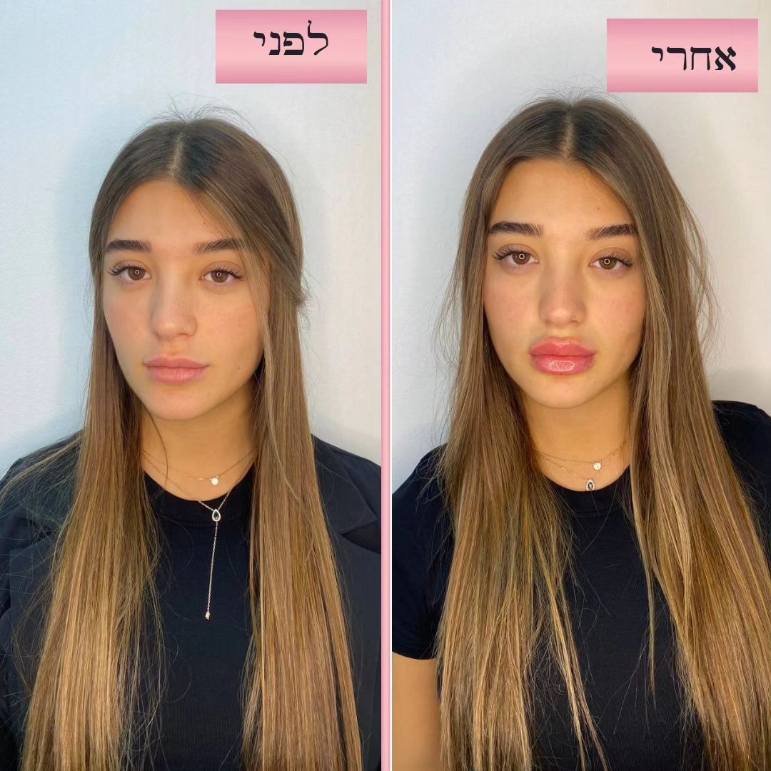 Lips for u by dr moran lahav
כל אחת והשפתיים שלה. התאמה אישית לכל אחת לפי סגנון השפתיים שלה